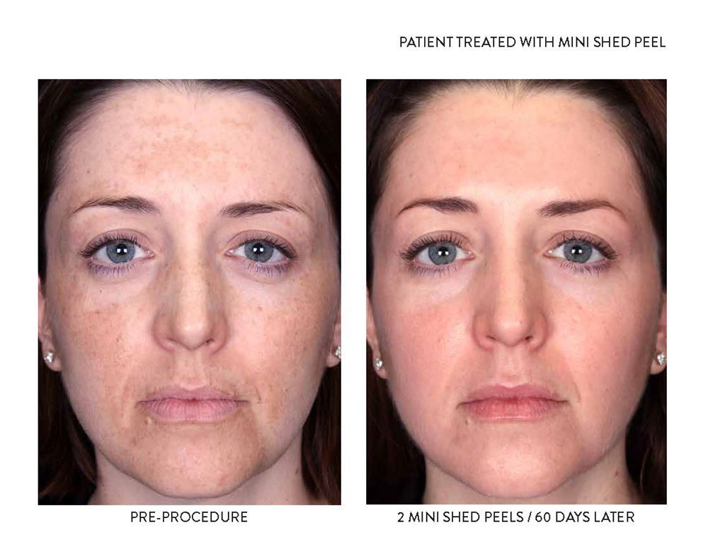 female patient's face before and after treatment with Mini Shed chemical peel