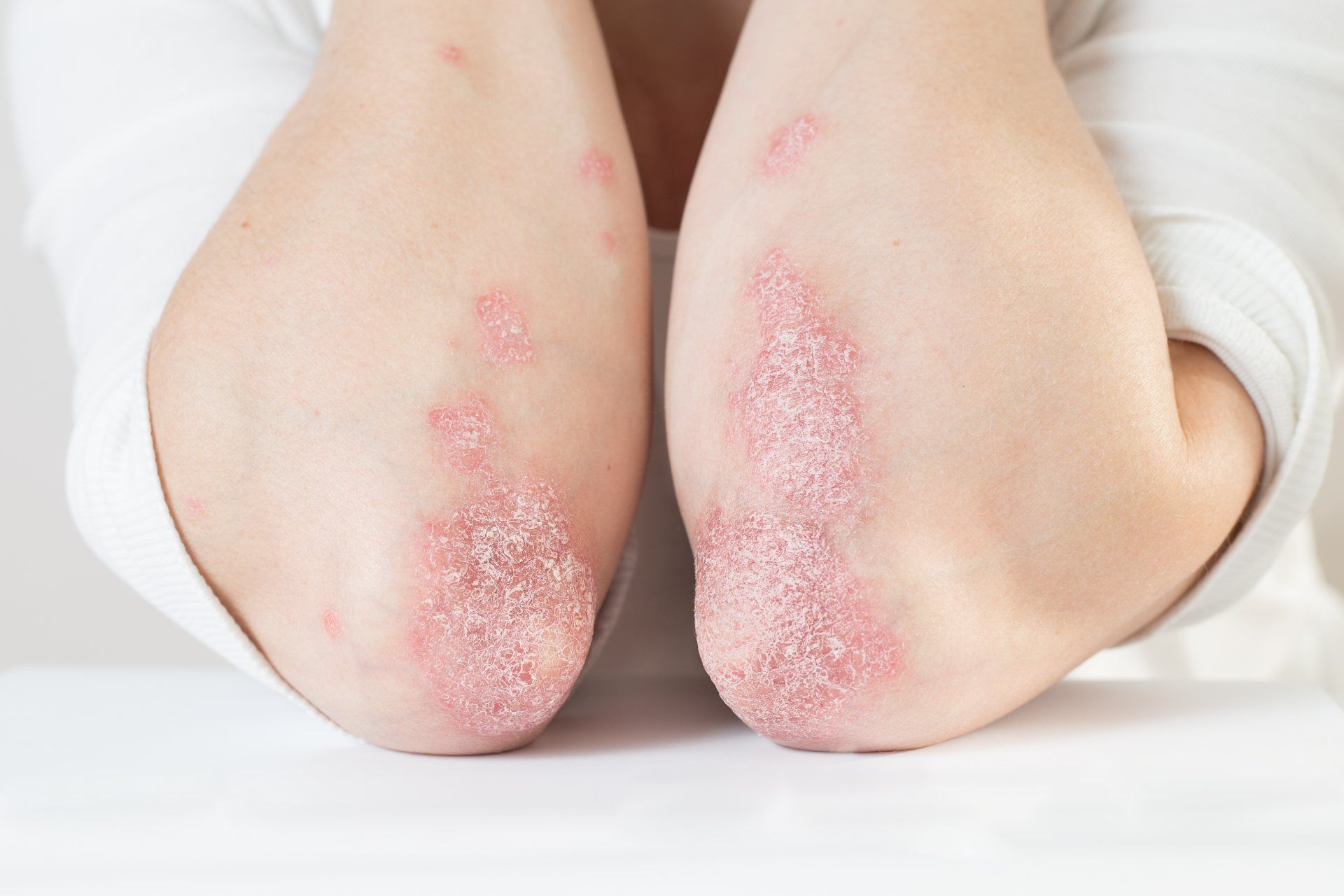 closeup of psoriasis patches on both of the patient's elbows