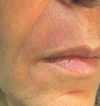 an after close up photo of an older woman's lips. wrinkles, lines and sagging are no longer visible.
