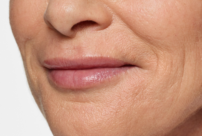 a close up shot of a woman 's bottom half face with wrinkles on her lips after demal fillers