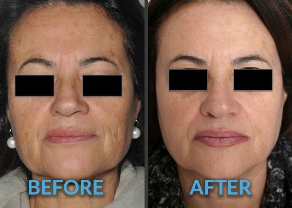 a before and after photo of a woman's entire face with both her eyes covered by a black strip. Her face is now smoother and has less wrinkles and glowing after getting laser resurfacing treatment. 