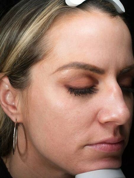 a close up of a woman 's face facing down 3/4 left with her eyes closed. After microneedling.