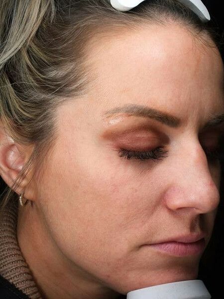 a close up of a woman 's face facing down  3/4 left with her eyes closed . before RF microneedling