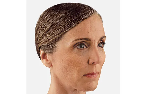 a close up of a woman 's face without makeup before Juvederm treatment