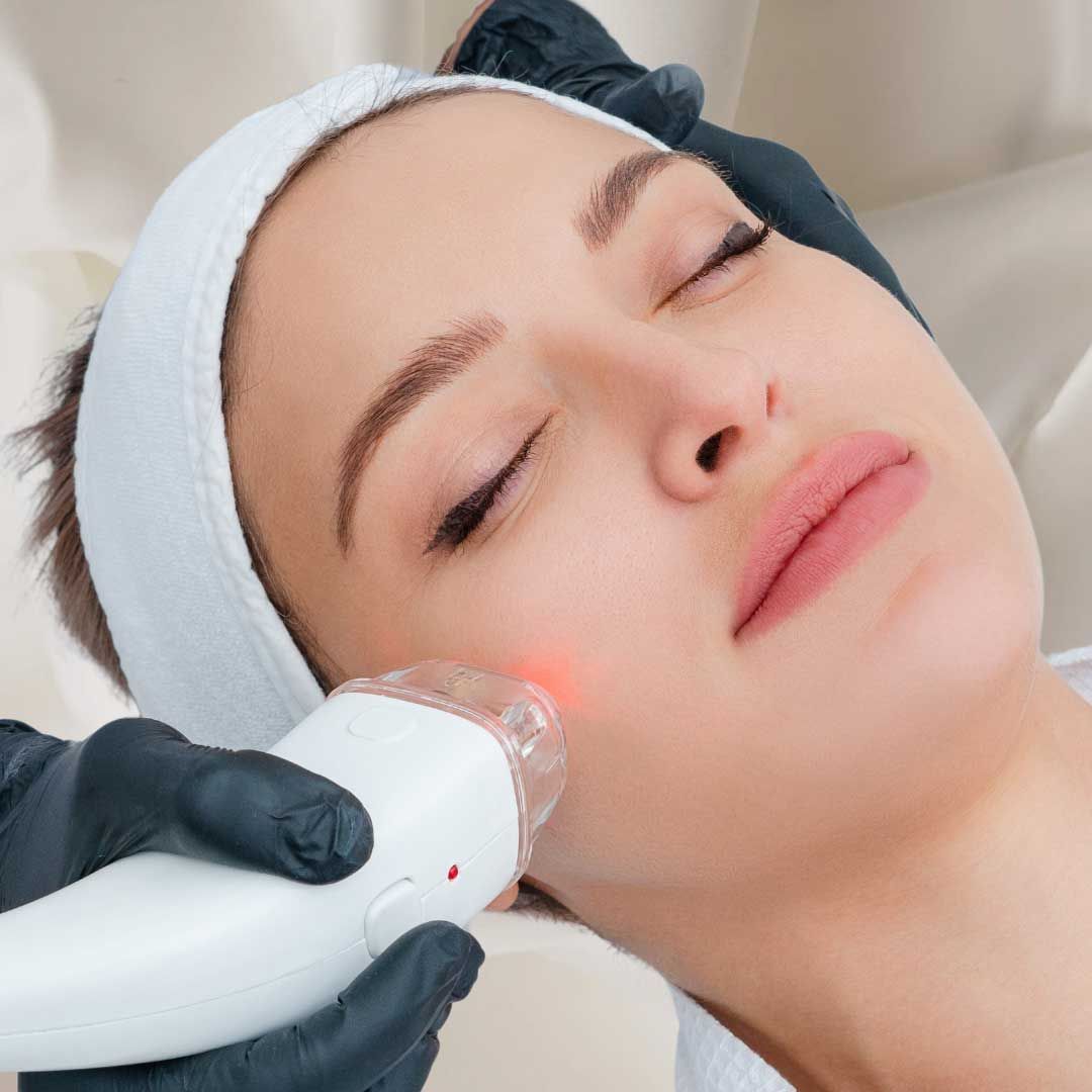 CO2 Laser treatment on face