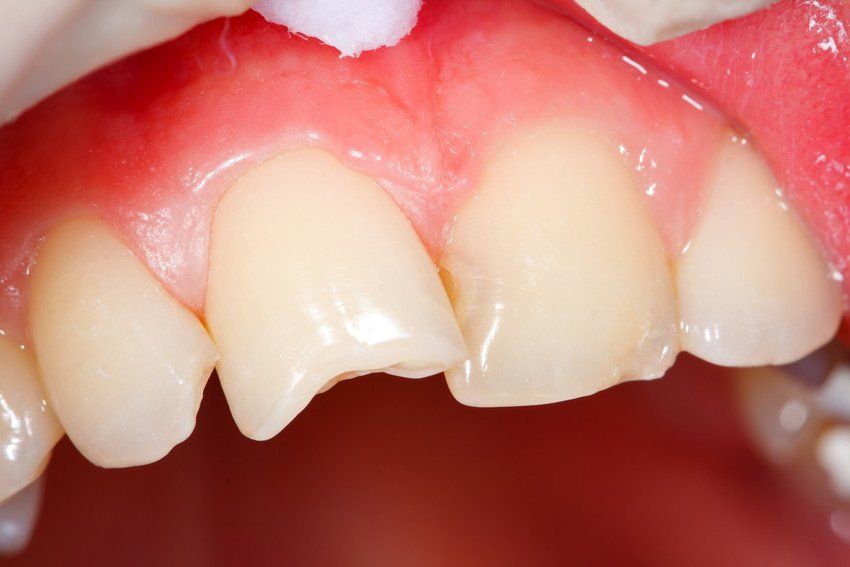 Poor teeth