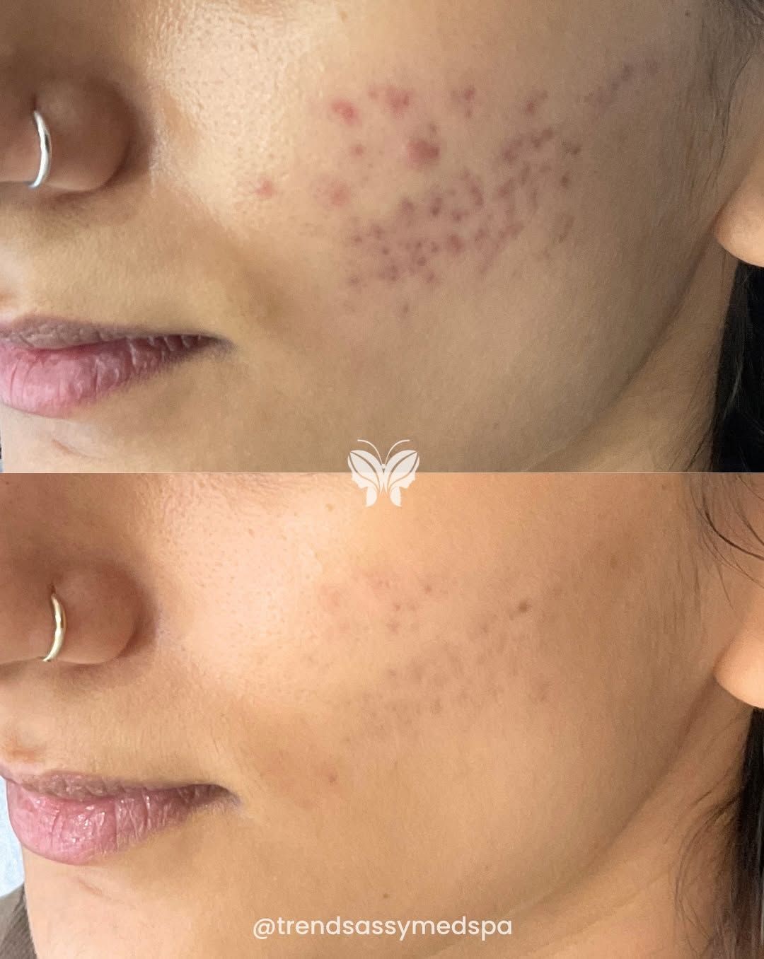 Before-and-after close-up of a cheek showing acne marks fading and clearer skin