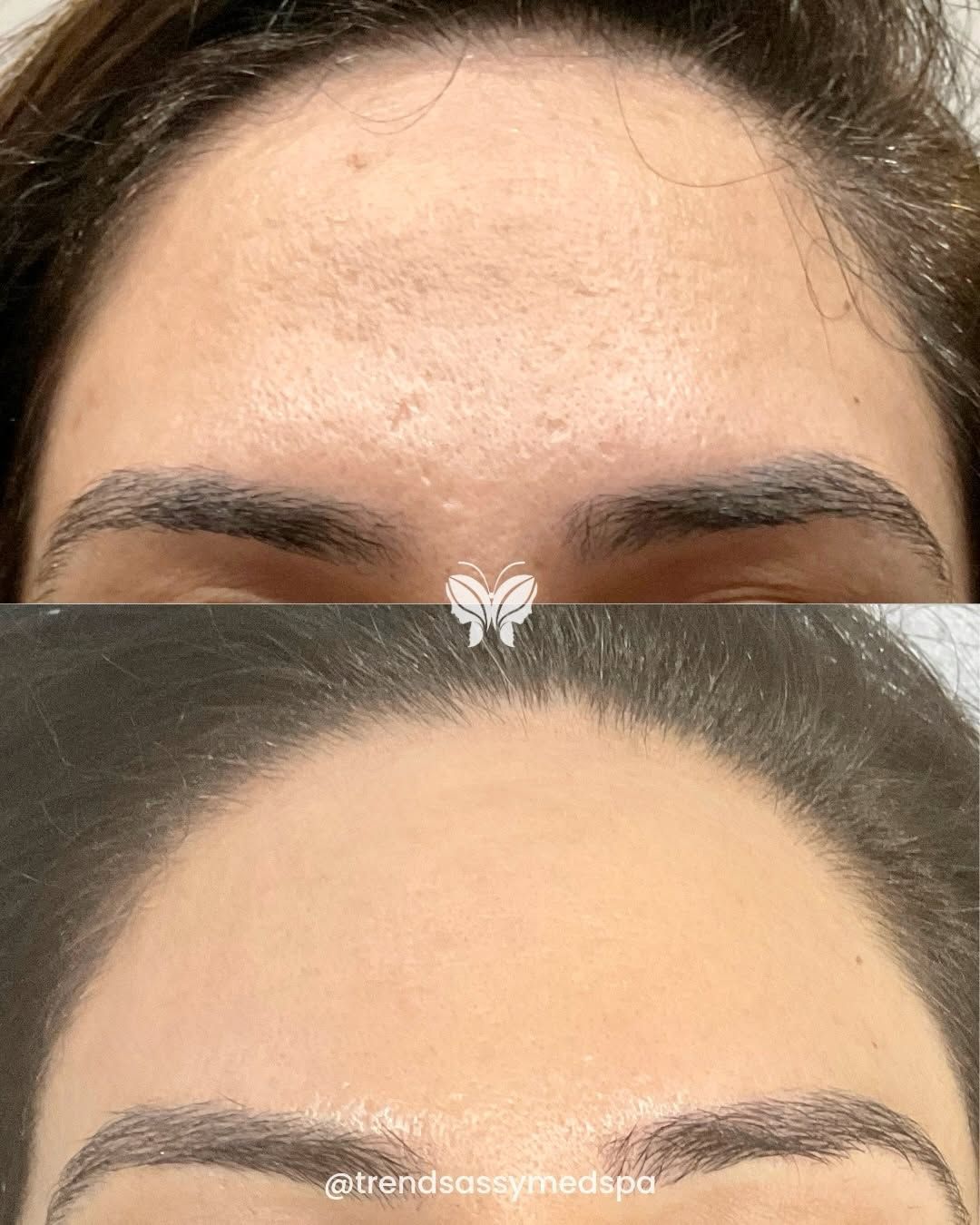 Before-and-after close-up of a forehead with fine lines and smoother skin after treatment