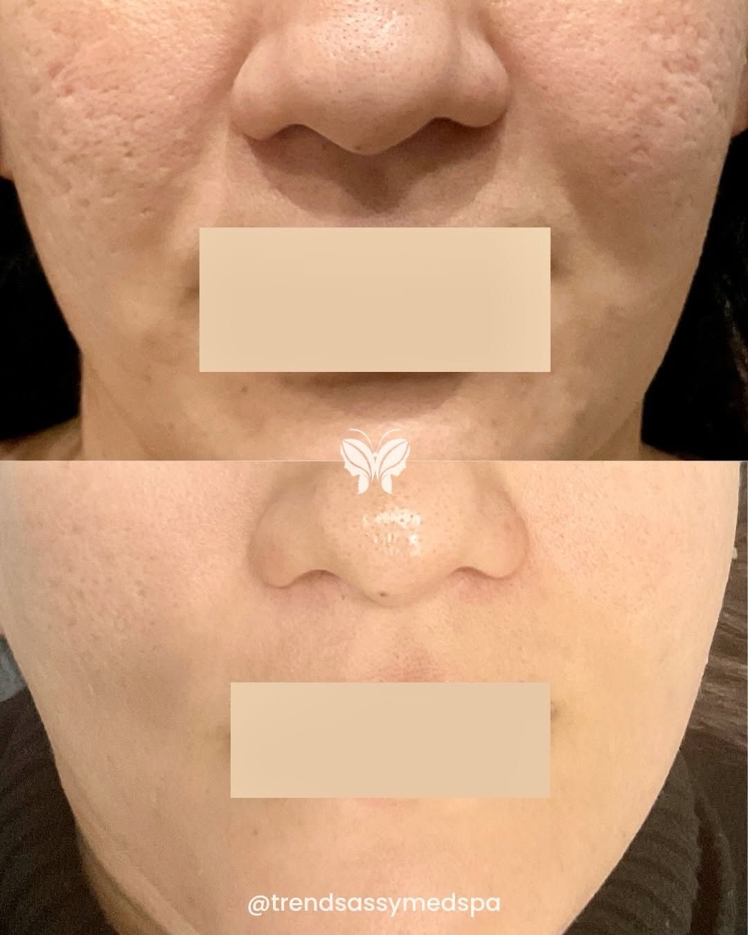 Close-up before-and-after of a nose with reduced redness and oiliness, mouth covered by beige blocks