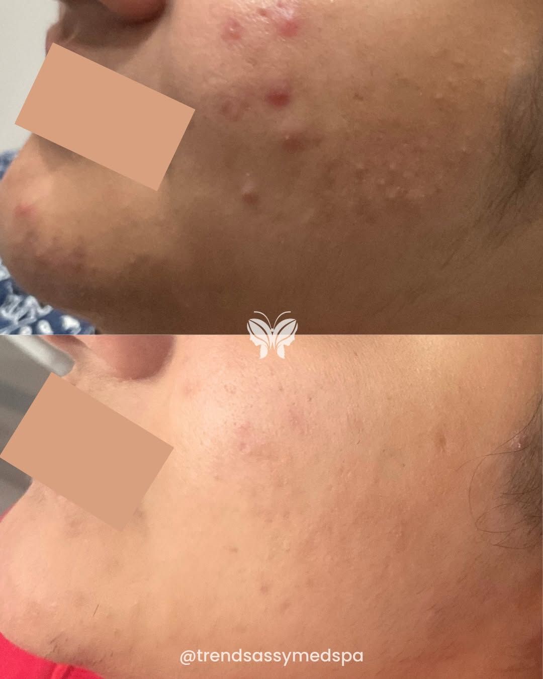 Side-by-side cheek close-up showing acne before and after treatment, with reduced redness and bumps.