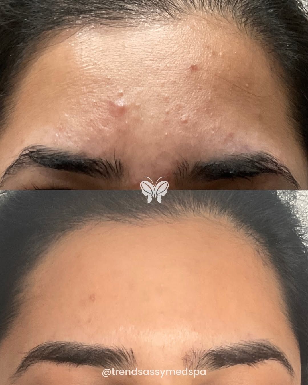 Before-and-after forehead skin comparison showing acne bumps and smoother skin after treatment