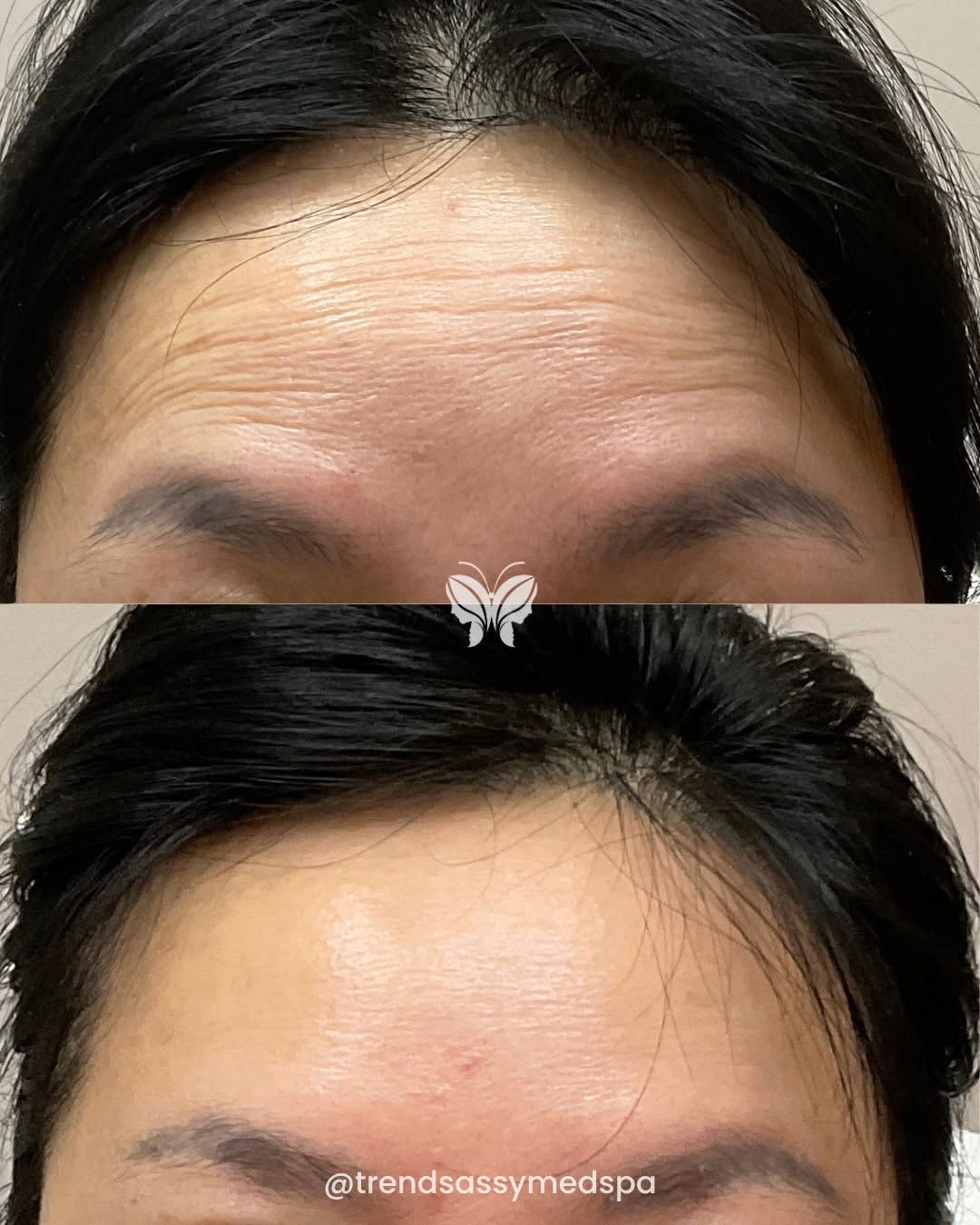 Close-up of a forehead with deep horizontal wrinkles, shown in two stacked views.
