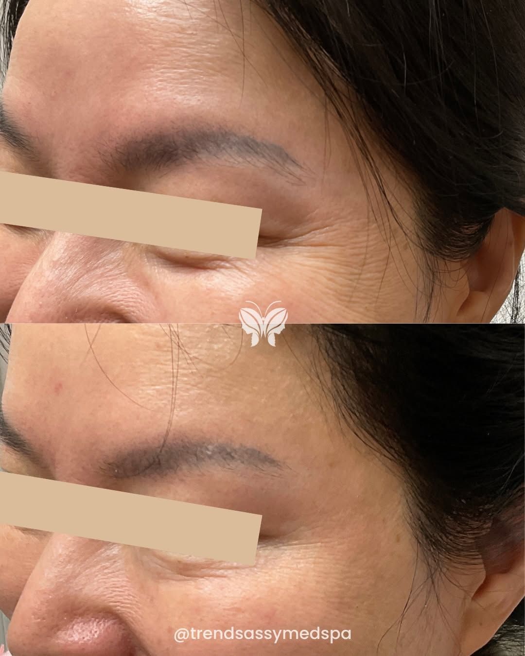 Side-by-side close-up of an eye area before and after treatment, showing reduced under-eye wrinkles.