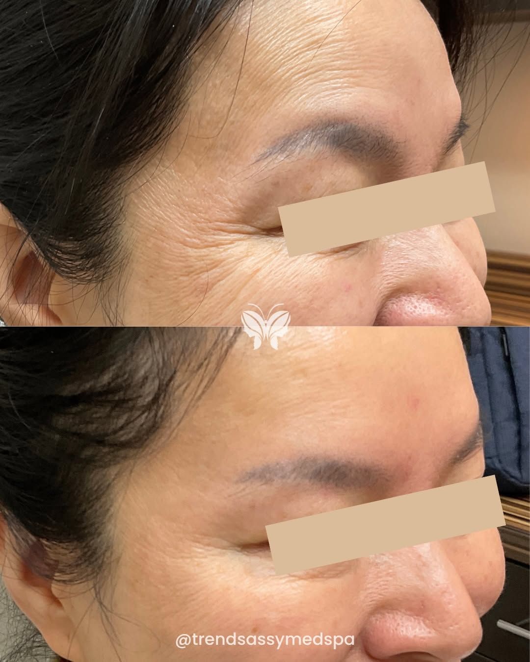 Side-by-side profile close-ups of a woman's face before and after treatment, showing reduced forehead lines and smoother skin