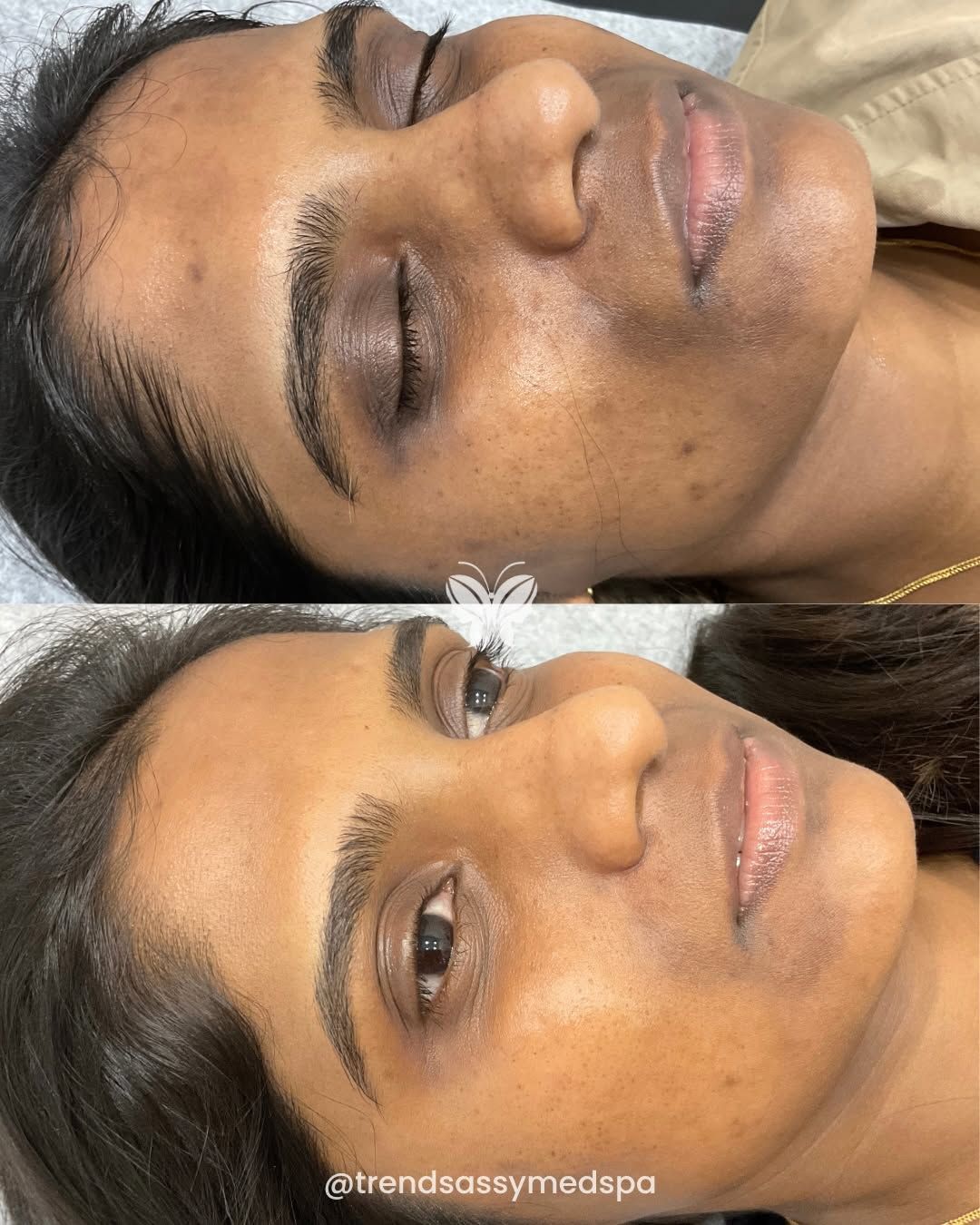 Before-and-after close-up of a face, showing eyes closed in the top image and open in the bottom image.