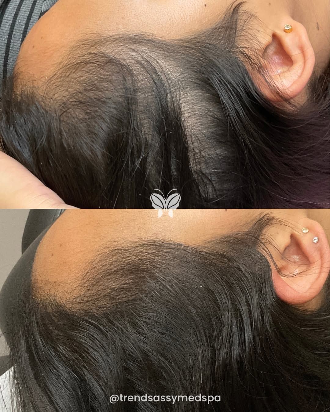 Before-and-after close-up of a scalp with thinning hair at the hairline and fuller coverage below.