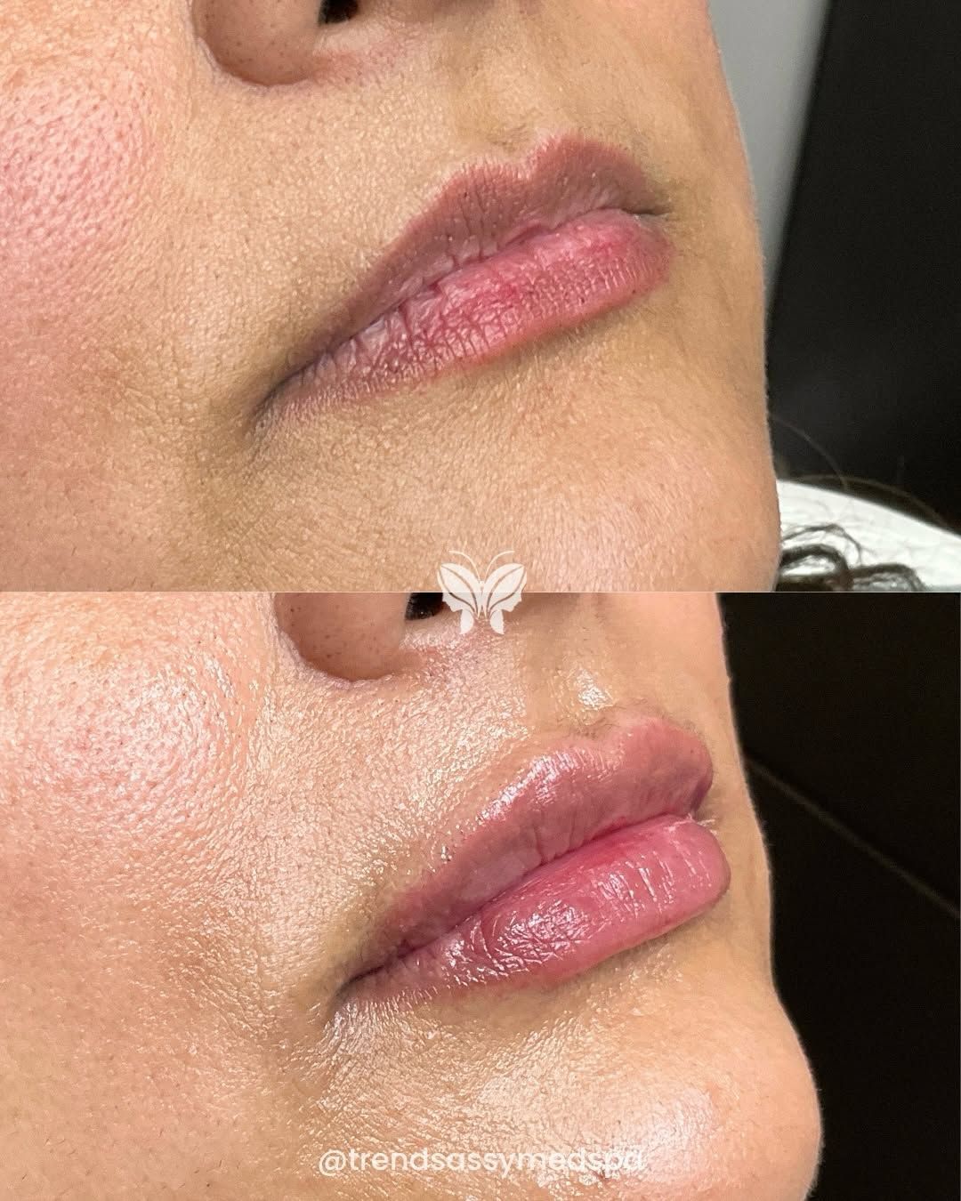 Side-by-side close-up of glossy pink lips and chin, showing before and after lip enhancement results