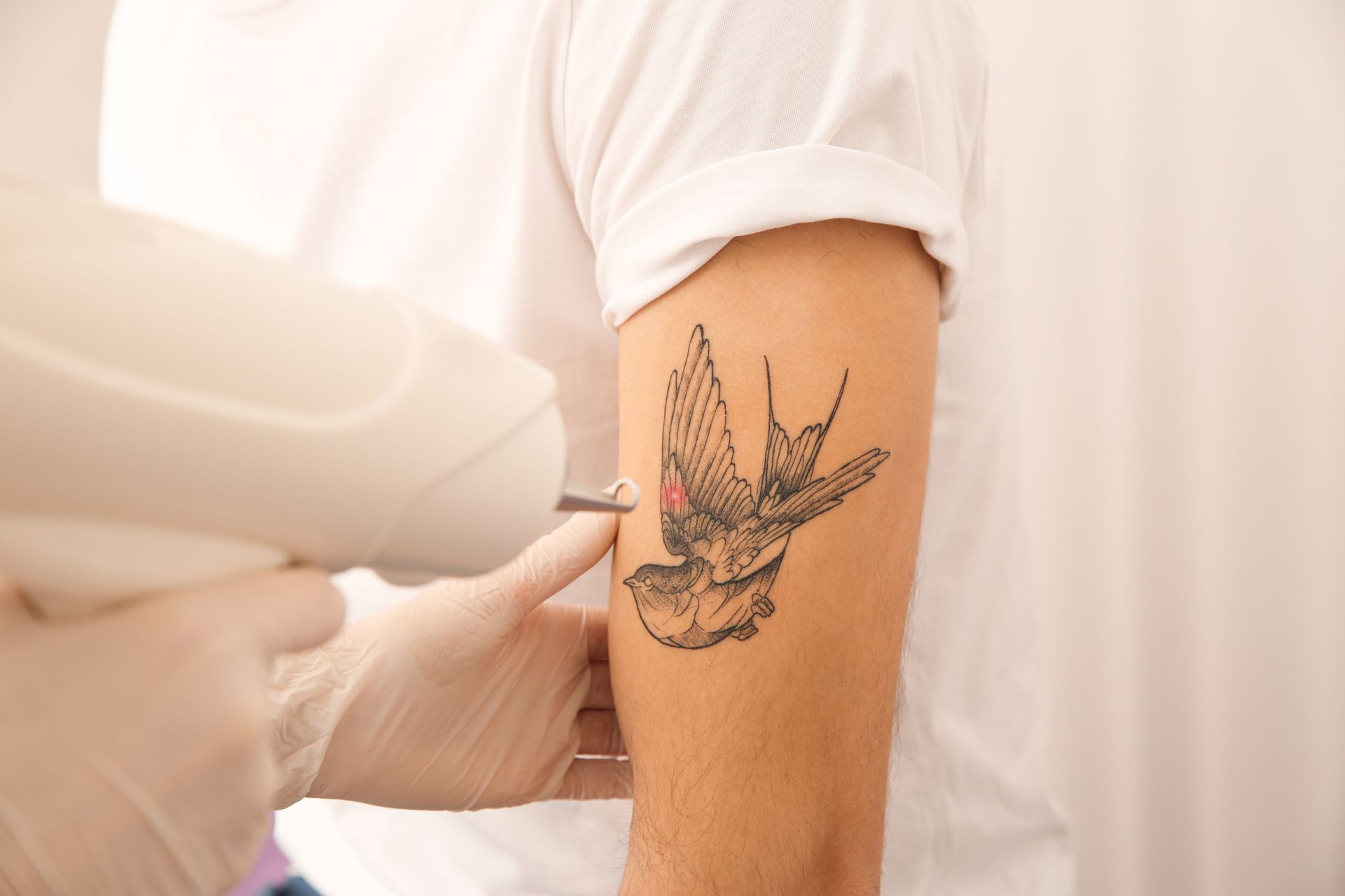 Laser tattoo removal on a forearm with a bird tattoo as a clinician holds the device.