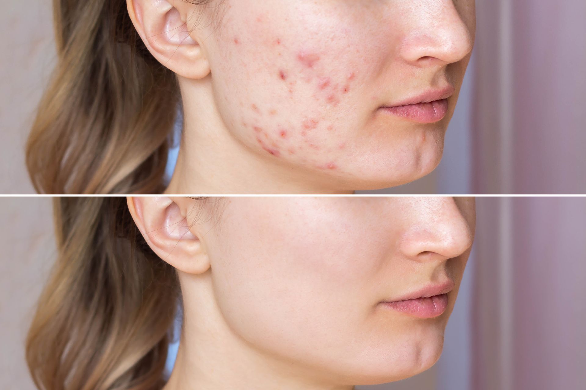 Before-and-after close-up of a cheek with acne scars, showing clearer skin below