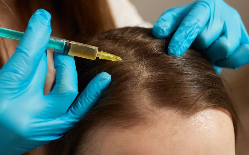 Gloved hands inject a syringe into a person’s scalp during a treatment procedure