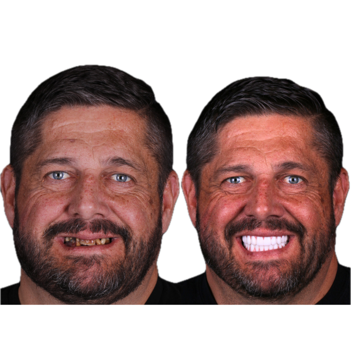 Side-by-side photo of a man before and after dental work. The after photo shows a brighter, complete smile.