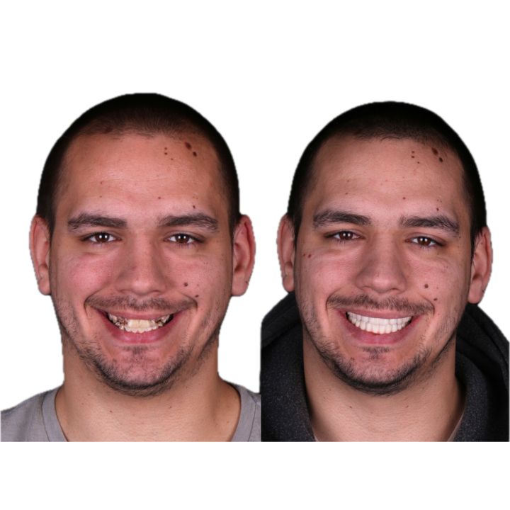 Two portraits of a person, before and after a dental procedure. Improved smile with whiter teeth.