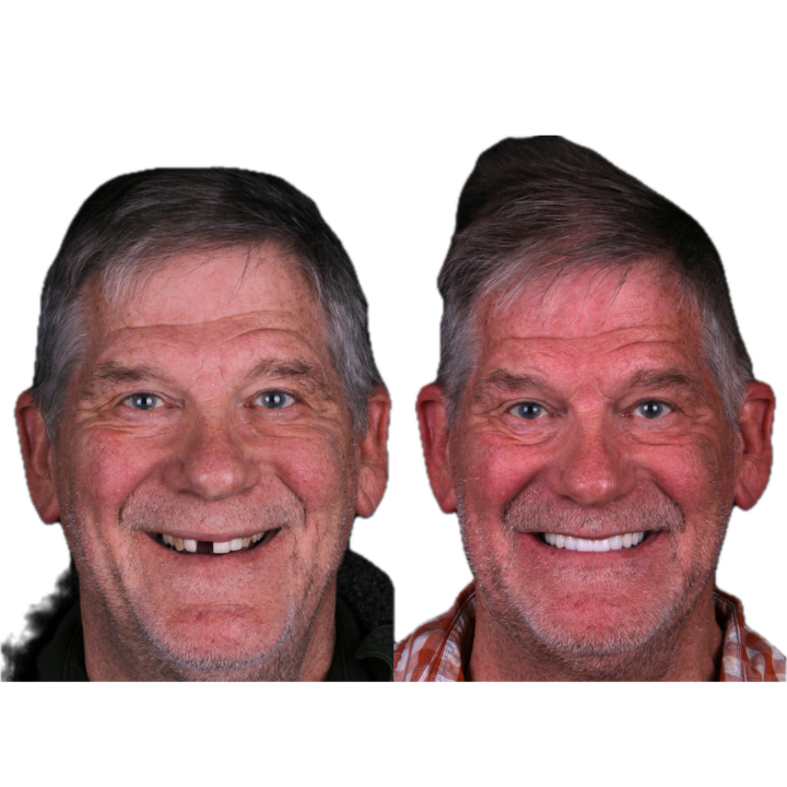 Side-by-side comparison of a man with missing teeth on the left and a full set of teeth on the right, smiling.