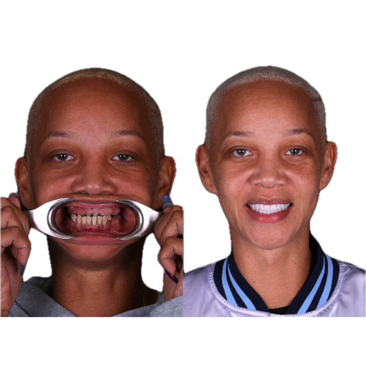 Woman before and after dental work, showing a smile transformation.