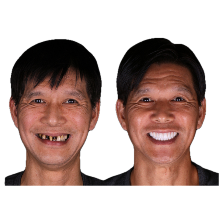 Before-and-after of a person's smile. The first shows missing teeth, and the second shows a bright, complete smile.