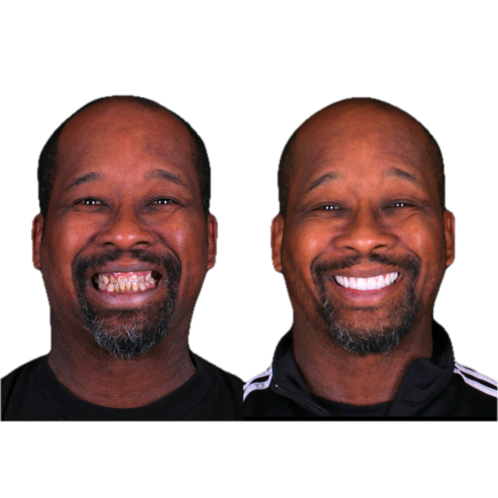 Side-by-side view of a man's teeth before and after dental work, showing a dramatic improvement in his smile.