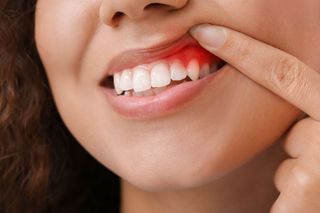 Woman pointing to inflamed, red gums near white teeth, possibly indicating a dental issue.
