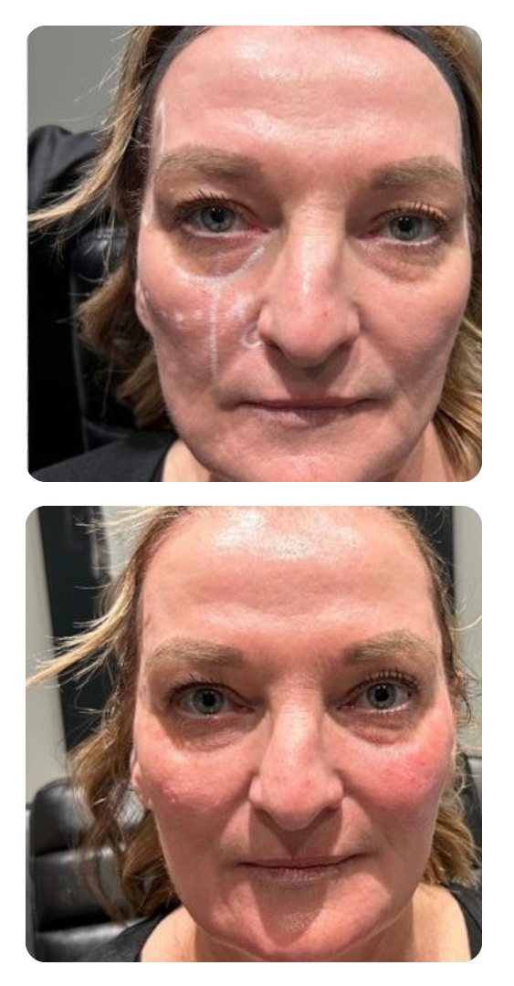 Before and after photos of a patients filler treatment.