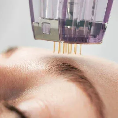 botox injection winnipeg
