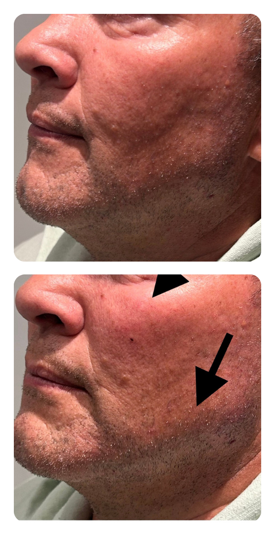 Before and after shows a reduction in jowling, improved skin tone, with arrows highlighting the structural change.