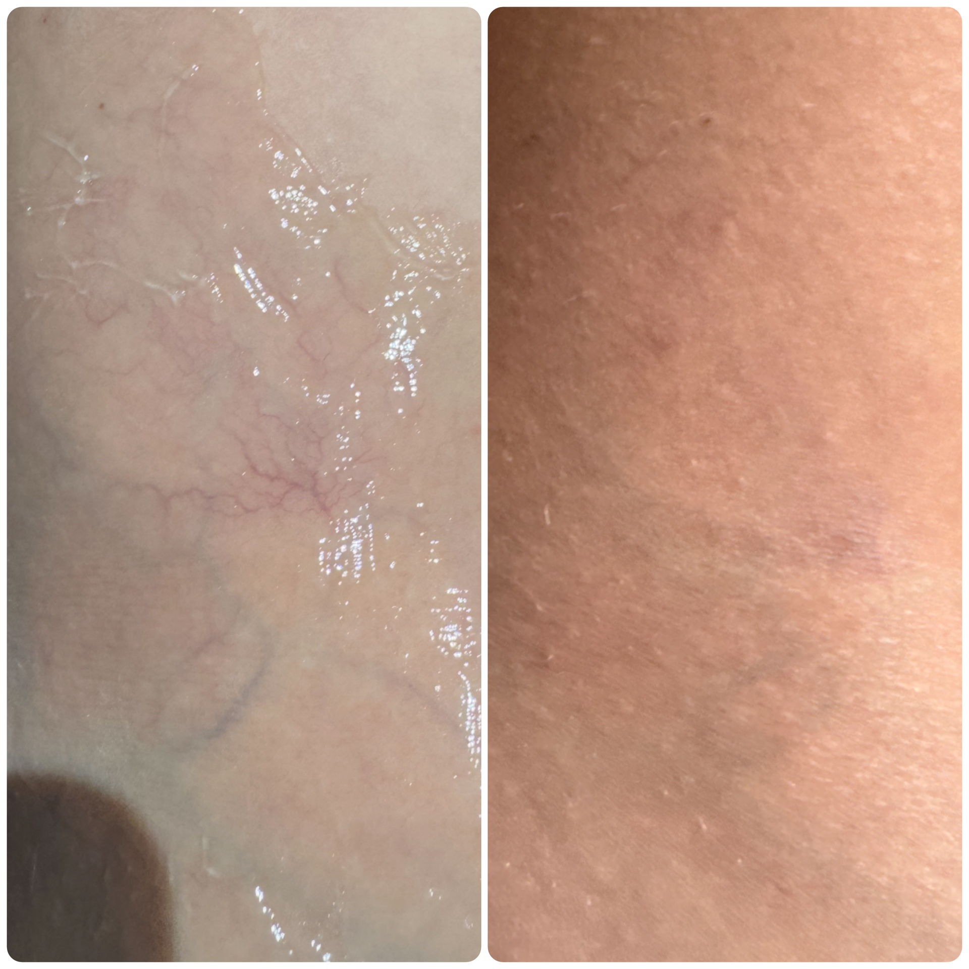 Two skin close-ups: one showing visible veins, the other with less visible veins.