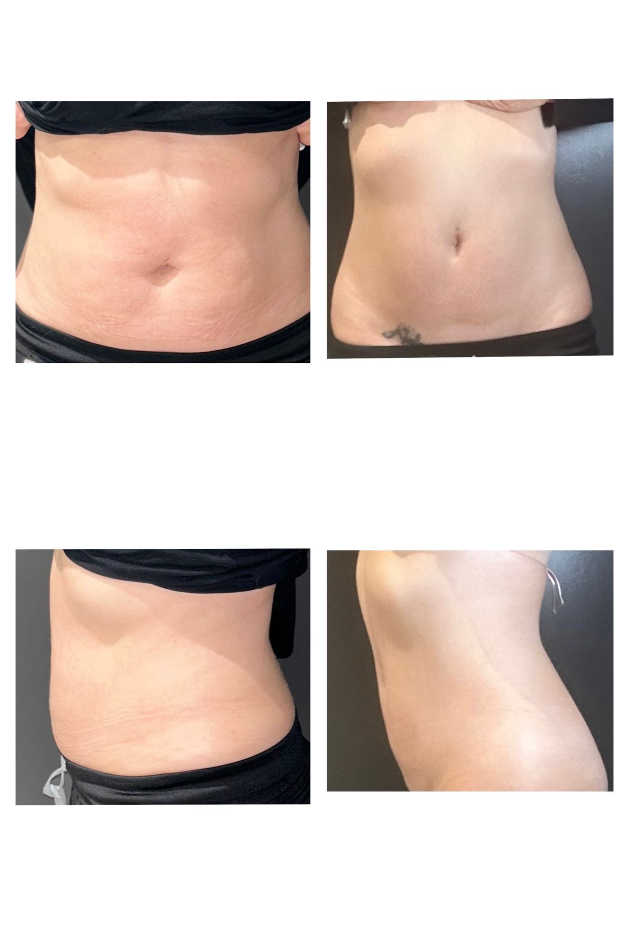 Before-and-after photos of a patient's abdomen.