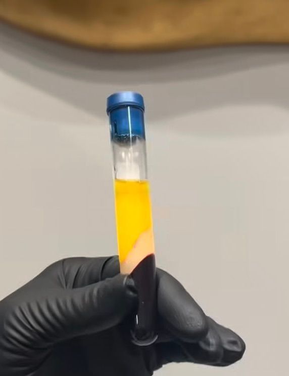 Hand holding a test tube with blood layers: red, buffy coat, and yellow plasma.