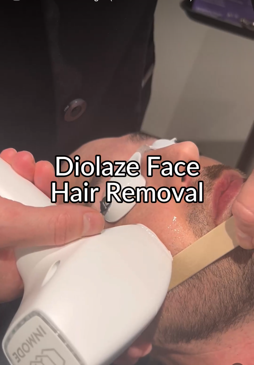 Patient receiving Diolaze laser hair removal on face at a clinic. 