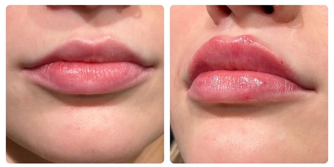 Before and after photos of a patient's lips, showing a change in size and plumpness.