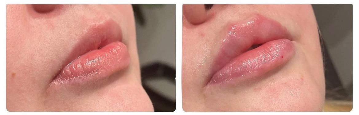 Lip Filler before and after