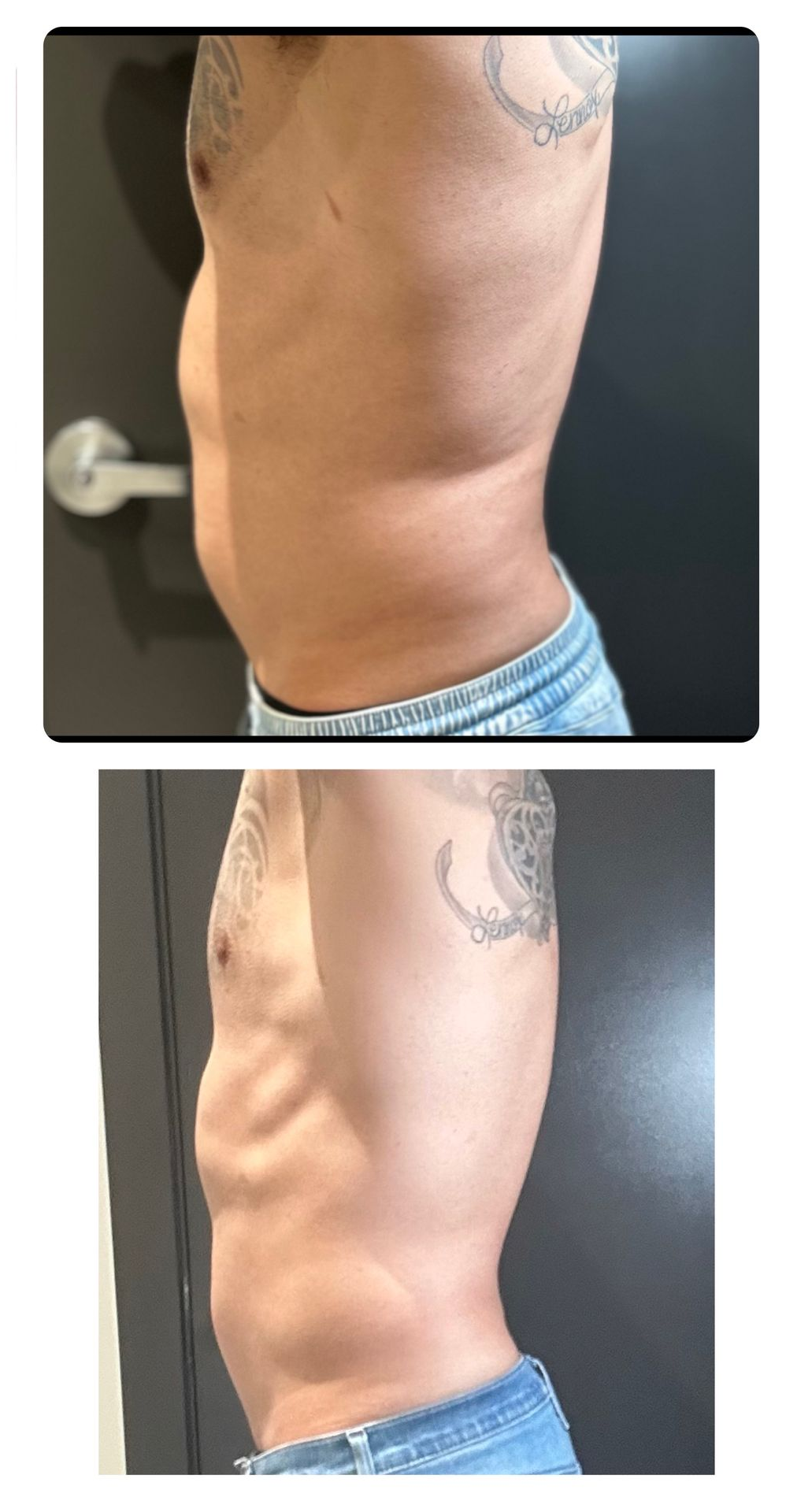 Before and after photos of a patient's abdomen after Emsculpt Neo