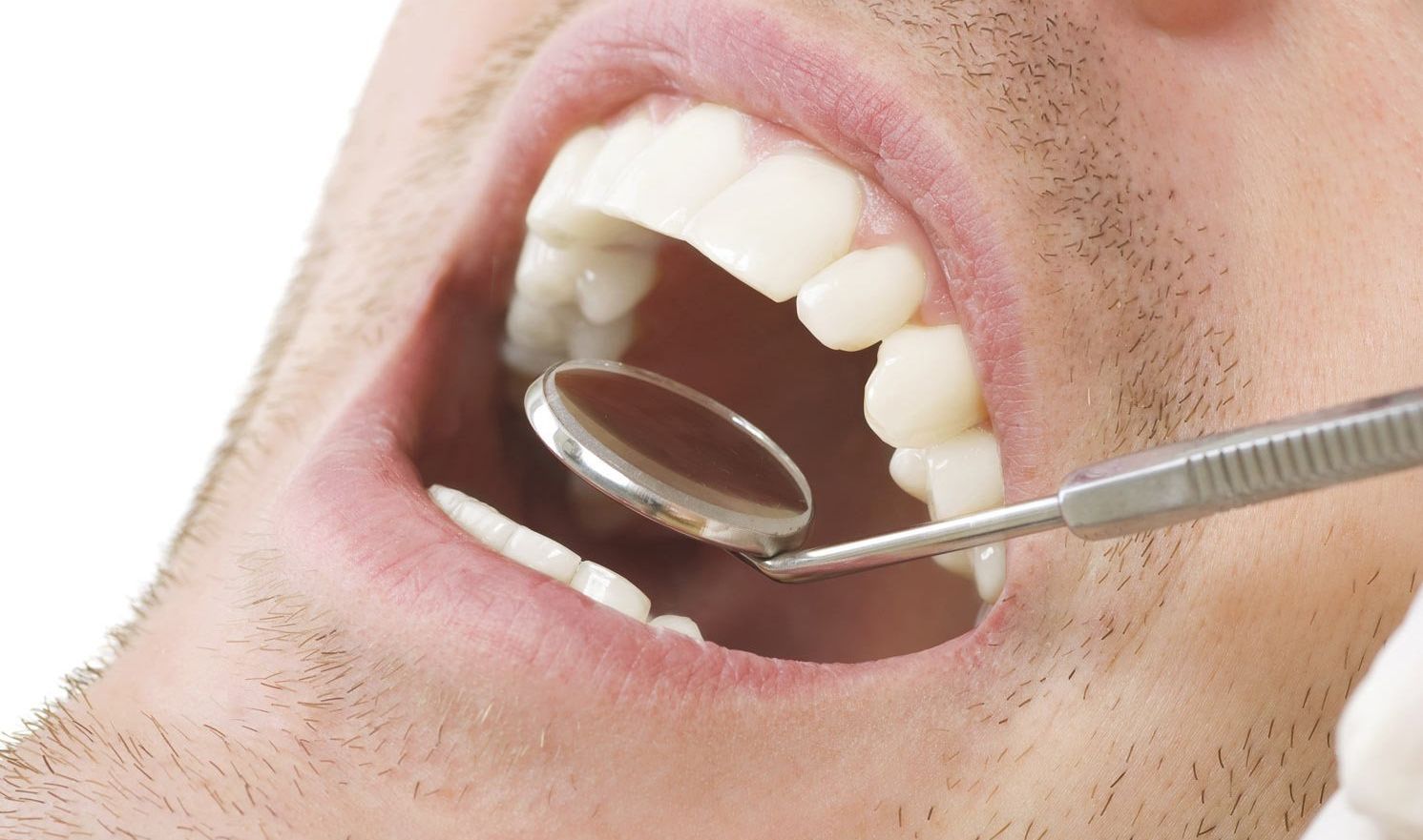 A man is getting his teeth examined by a dentist.