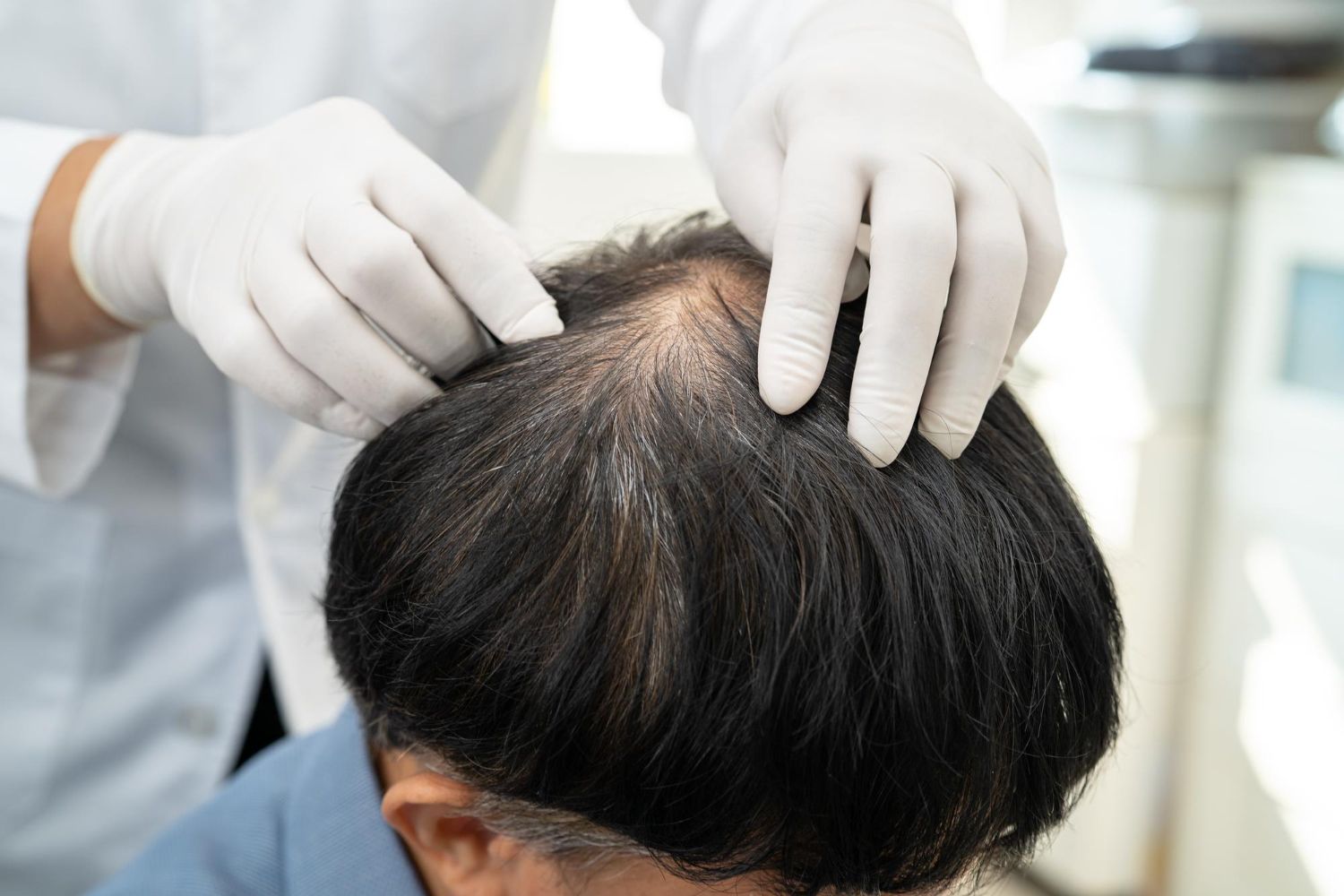 PRP for Hair Loss: How Can It Help? 
