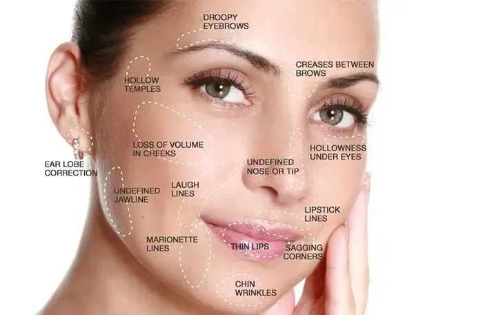 Target Areas for Dermal Fillers