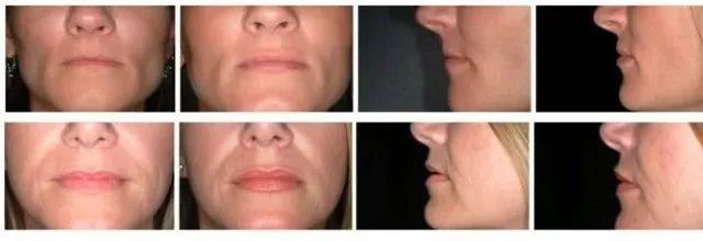 Before and after photos of a person's mouth and chin from different angles. The