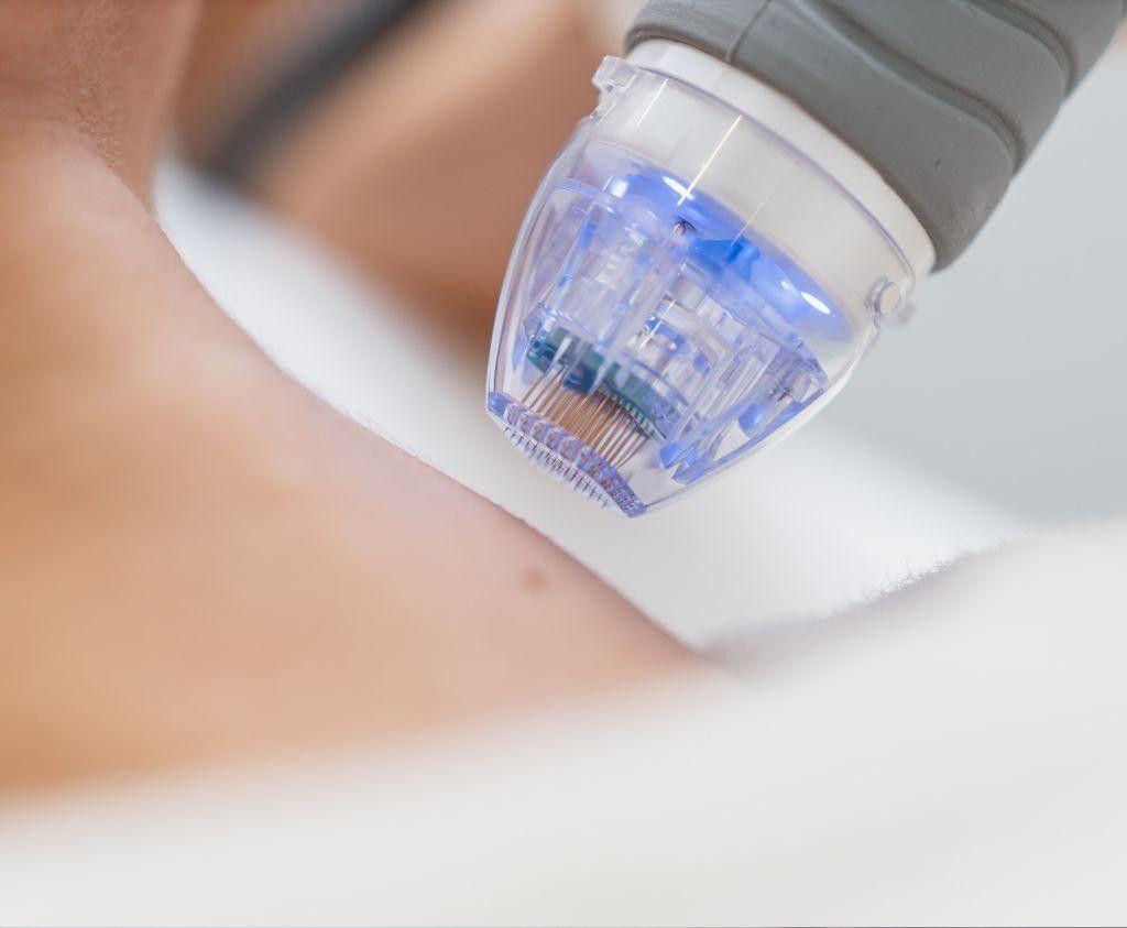 How RF Microneedling Works Beneath the Skin