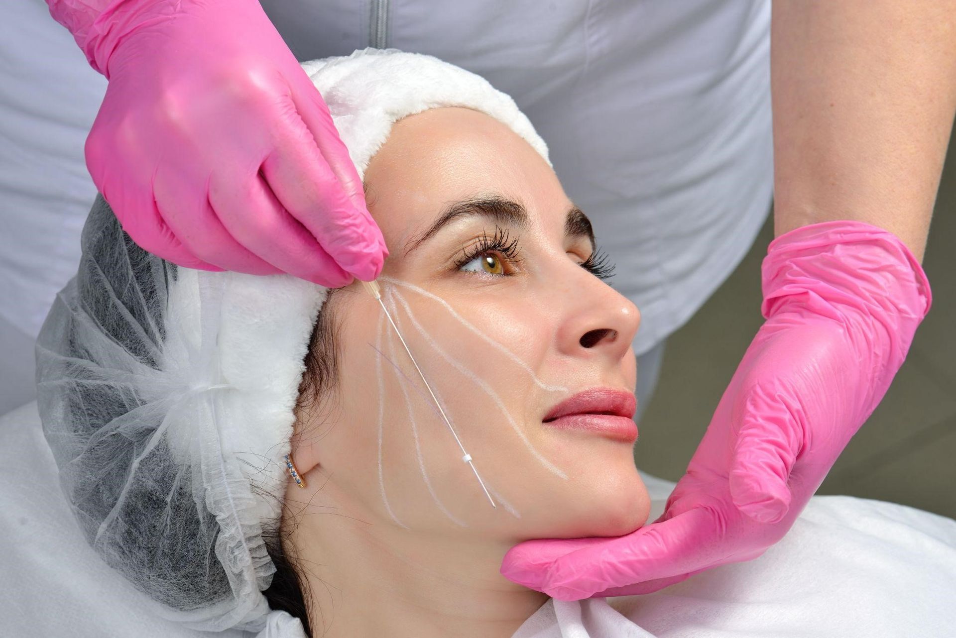 Target Areas for PDO Thread Lifts