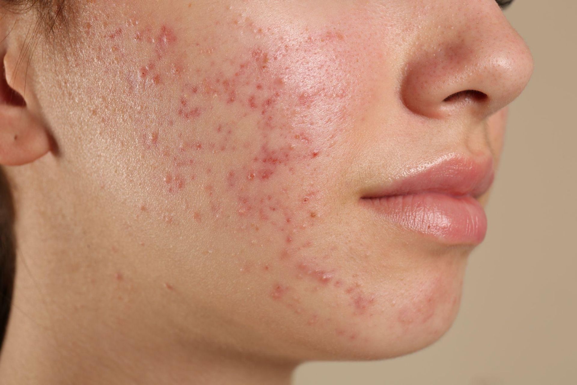 The Life Cycle of Acne