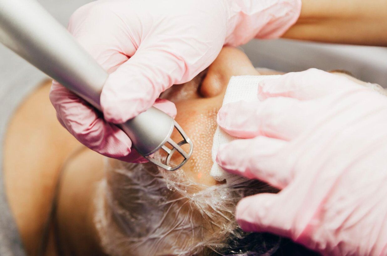 What Conditions Can Fractional CO2 Laser Treat?