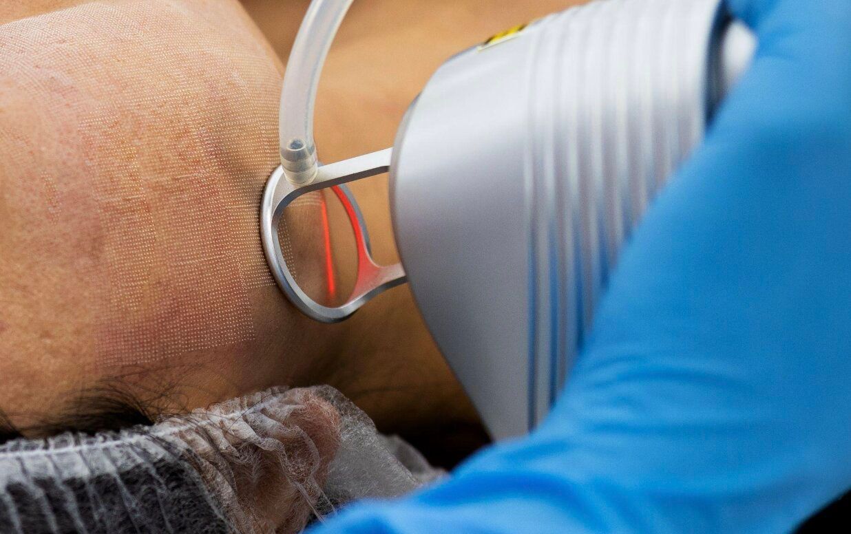 What Is Fractional CO2 Laser? A Medical Overview